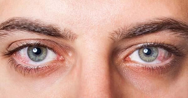 Vảy nến mí mắt có thể dẫn tới bệnh viêm màng bồ đào